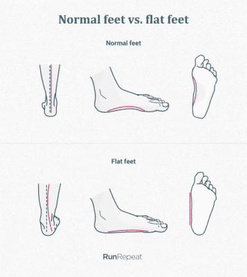normal feet vs flat feet